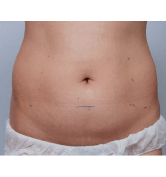 ANTES-ABDOMEN