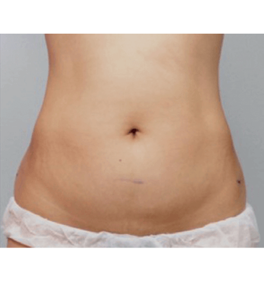 DESPUES-ABDOMEN
