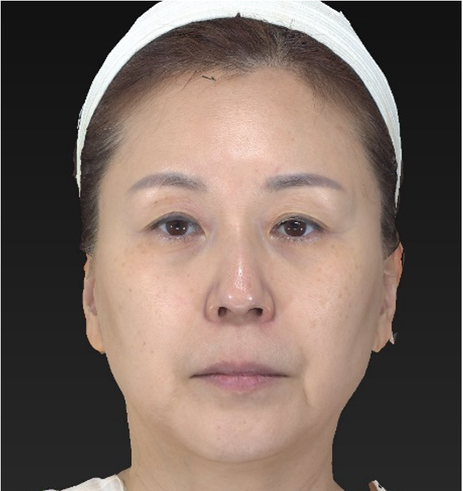 12 semanas después del tratamiento - volnewmer