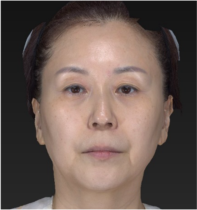 antes del tratamiento - volnewmer