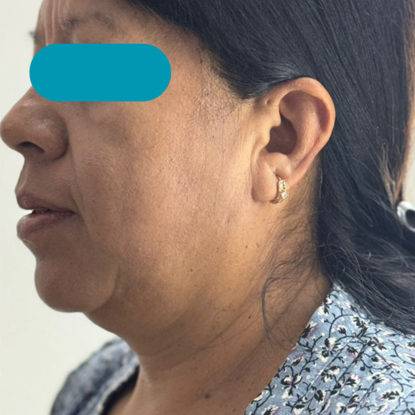 antes-2 antes-2
