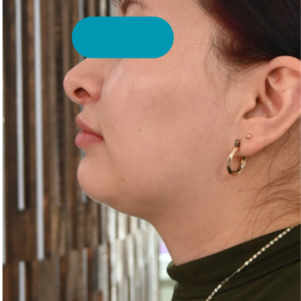 antes antes