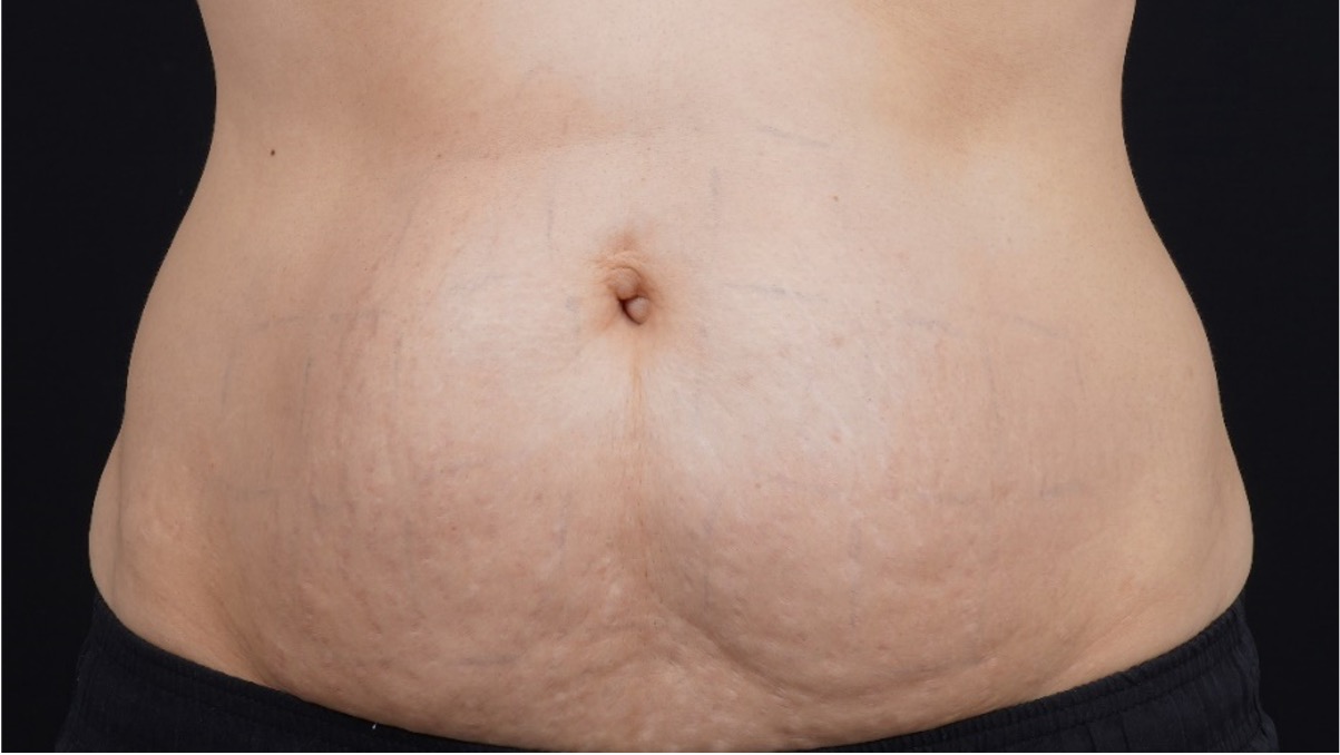 panza despues2
